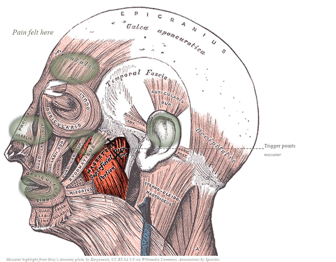 Side view of the head from Gray's Anatomy with the masseter muscle highlighted in red along the jaw, X marks on the muscle, and sage clouds at the temple, teeth, cheek, and ear where pain refers.