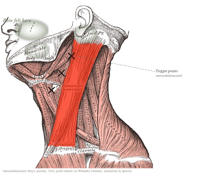 Side view of the head and neck (Gray's Anatomy illustration) showing the sternocleidomastoid muscle in red, with X marks along the muscle and sage clouds on the forehead, cheek, and behind the ear where pain refers.