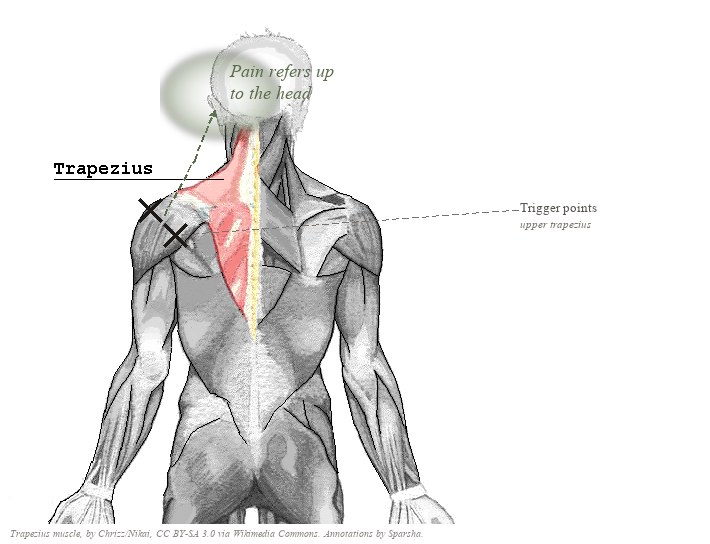 Anatomical illustration of the trapezius muscle (highlighted in red on the upper back), with X marks on the upper trapezius and a sage cloud over the head indicating where pain refers.